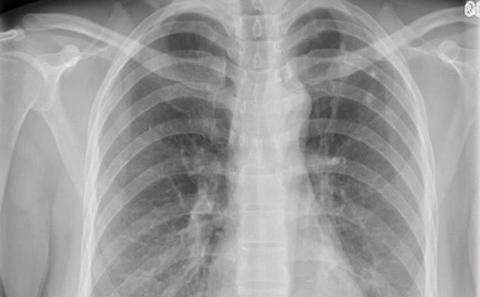 lung xray